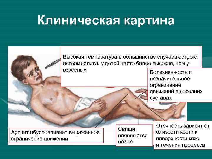 Клиническая картина Высокая температура в большинстве случаев острого остеомиелита, у детей часто более высокая,