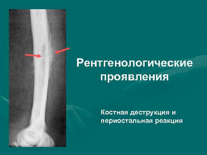 Рентгенологические проявления Костная деструкция и периостальная реакция 