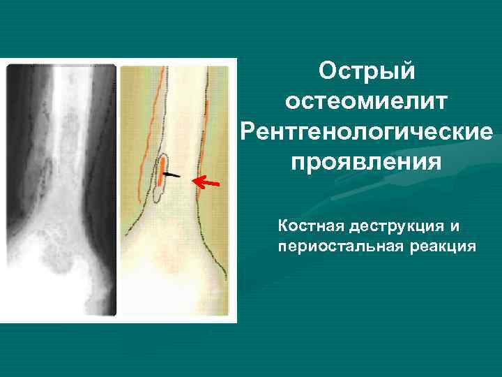 Периостальная костная мозоль