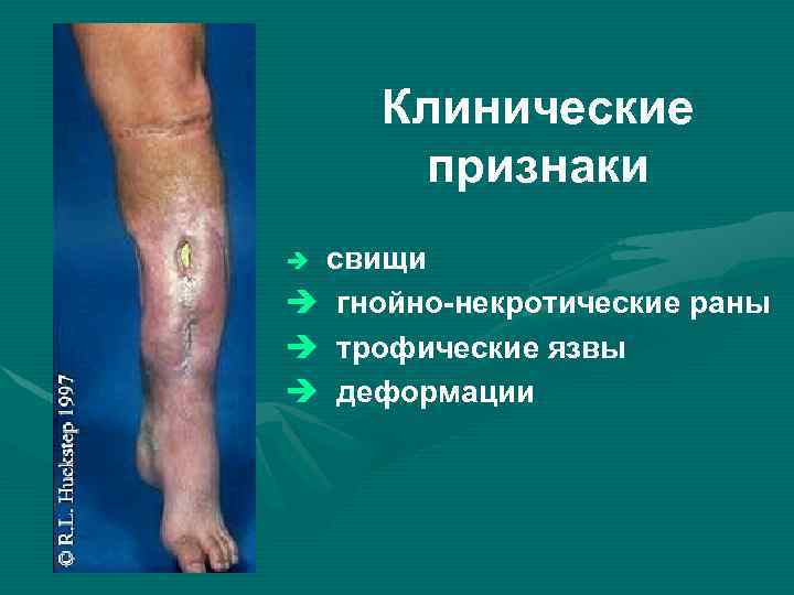 Клинические признаки свищи è гнойно-некротические раны è трофические язвы è деформации è 