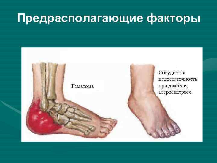 Предрасполагающие факторы Гематома Сосудистая недостаточность при диабете, атеросклерозе 