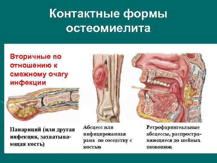 Контактные формы остеомиелита Вторичные по отношению к смежному очагу инфекции Панариций (или другая инфекция,