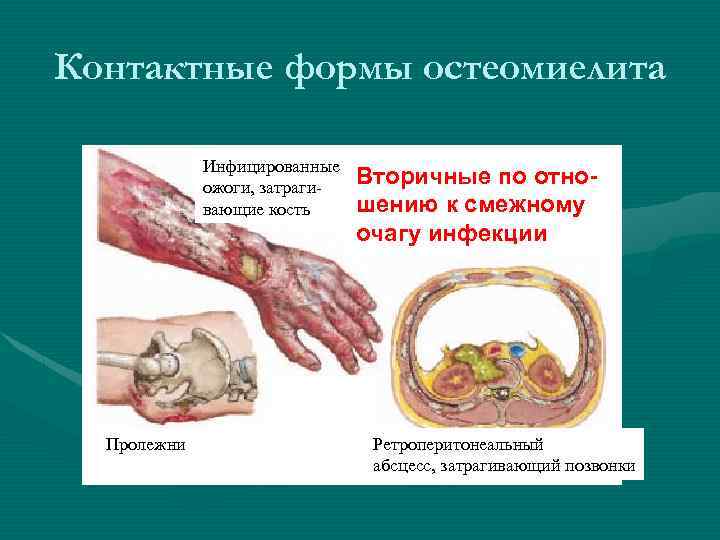 Контактные формы остеомиелита Инфицированные ожоги, затрагивающие кость Пролежни Вторичные по отношению к смежному очагу