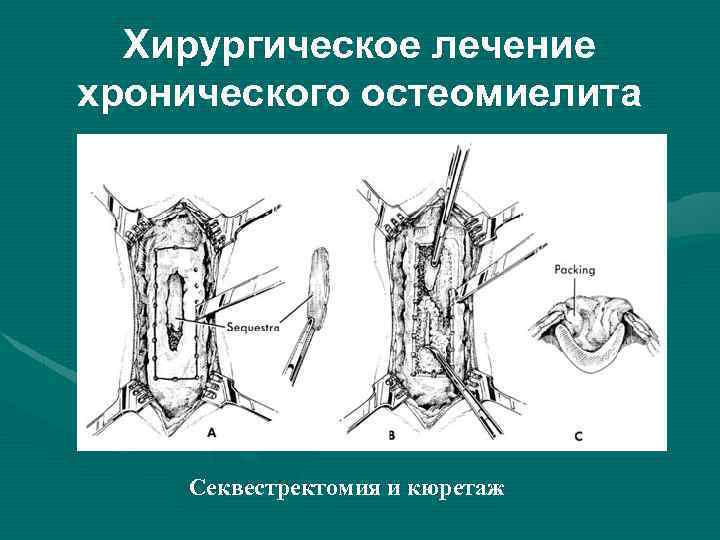 Остеомиелит лечение. Радикальная хирургическая обработка остеомиелитического очага. Хронический остеомиелит схема. Гематогенный остеомиелит операция. Хирургическое лечение остеомиелита.