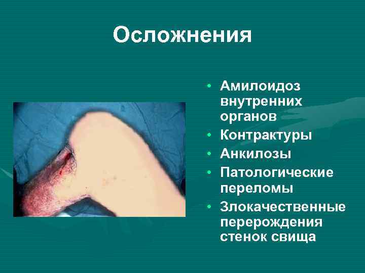 Осложнения • Амилоидоз внутренних органов • Контрактуры • Анкилозы • Патологические переломы • Злокачественные