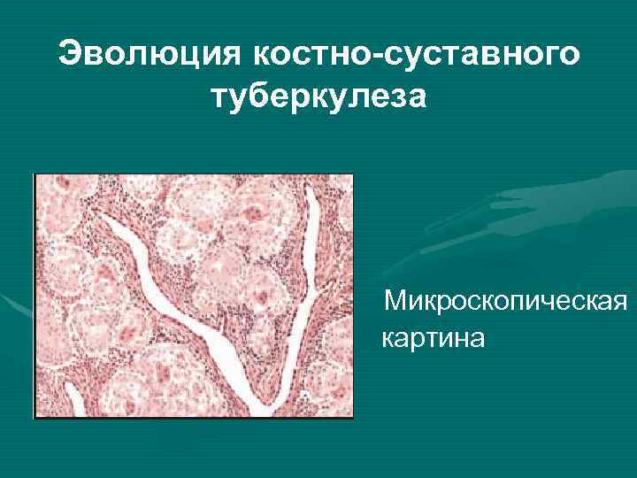 Эволюция костно-суставного туберкулеза Микроскопическая картина 