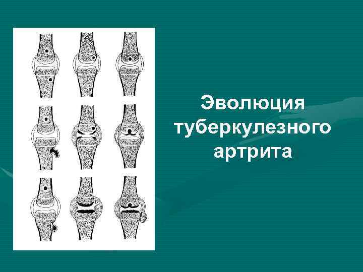 Эволюция туберкулезного артрита 