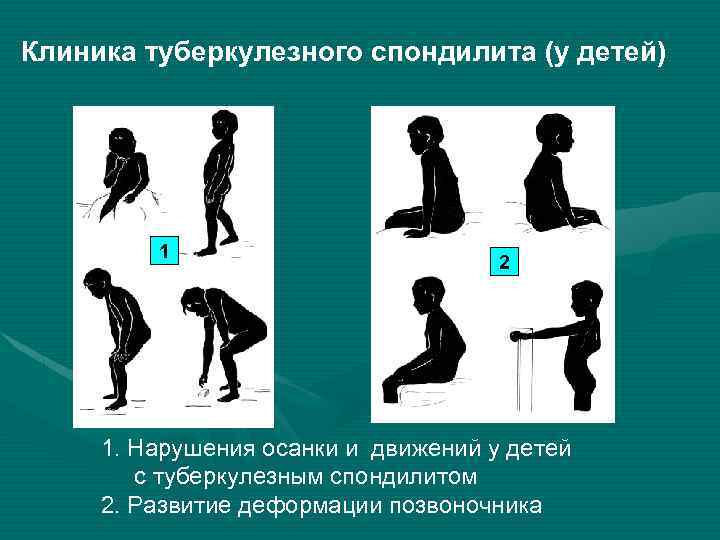 Клиника туберкулезного спондилита (у детей) 1 2 1. Нарушения осанки и движений у детей
