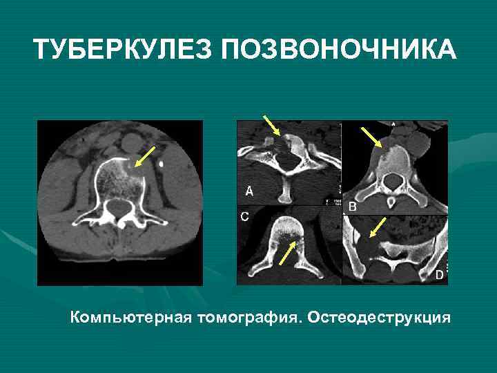 Презентация на тему туберкулез костей и суставов