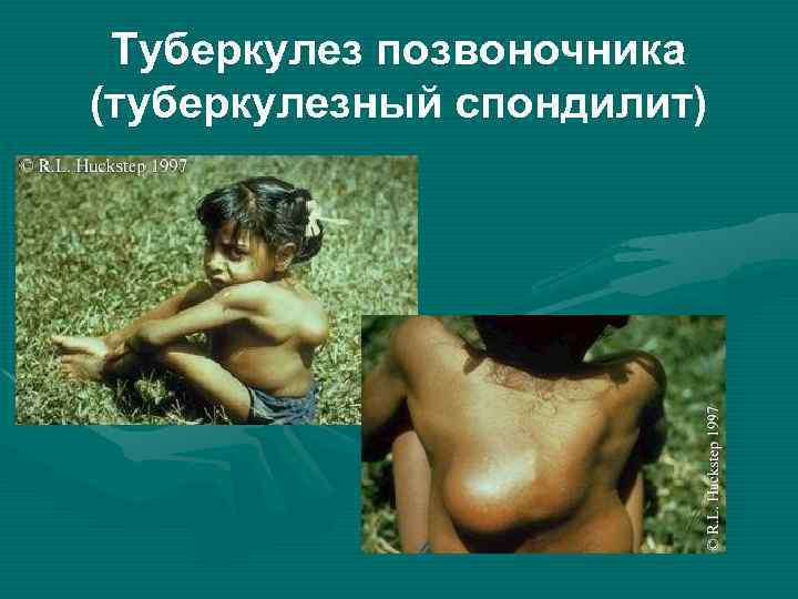 Туберкулез позвоночника (туберкулезный спондилит) 