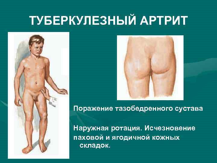 ТУБЕРКУЛЕЗНЫЙ АРТРИТ Поражение тазобедренного сустава Наружная ротация. Исчезновение паховой и ягодичной кожных складок. 