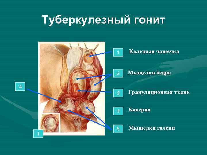 Туберкулезный гонит 1 Коленная чашечка 2 Мыщелки бедра 3 Грануляционная ткань 4 Каверна 5