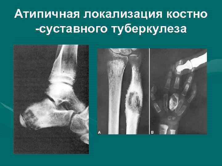 Атипичная локализация костно -суставного туберкулеза 