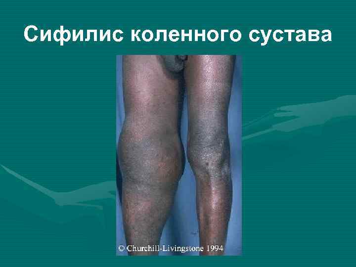 Сифилис коленного сустава 