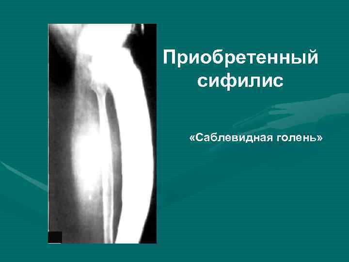 Приобретенный сифилис «Саблевидная голень» 