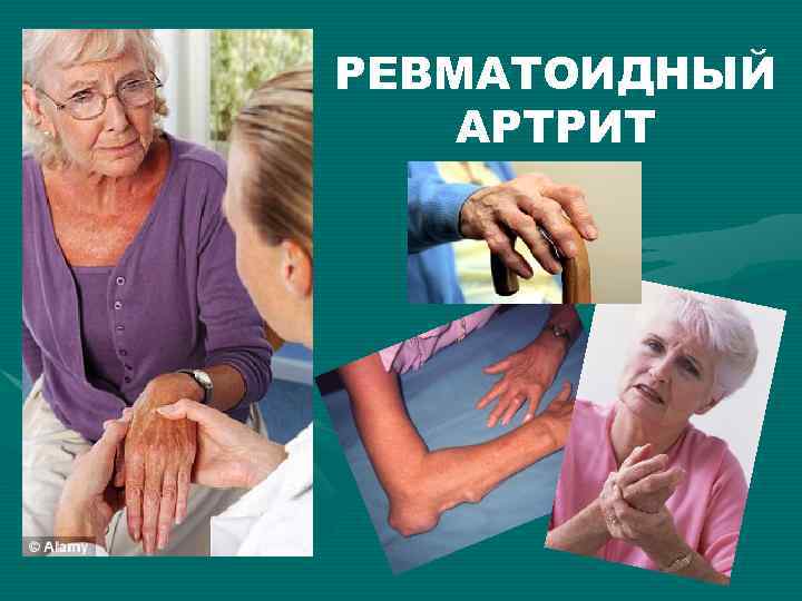 РЕВМАТОИДНЫЙ АРТРИТ 