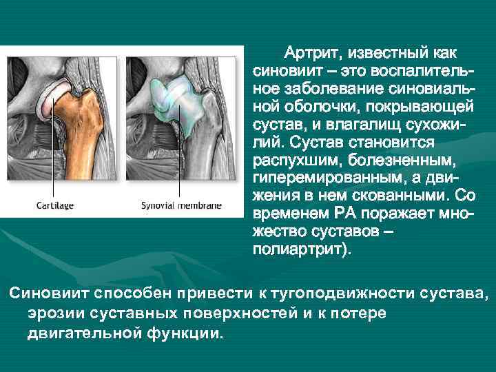 Артрит, известный как синовиит – это воспалительное заболевание синовиальной оболочки, покрывающей сустав, и влагалищ