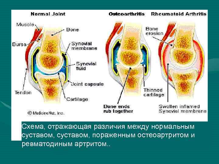 Нормальный сустав. Воспалительное поражение суставов. Заболевание костей и суставов. Остеоартрит и остеоартроз различия. Различия между остеоартрит и артрит.