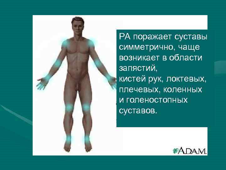 РА поражает суставы симметрично, чаще возникает в области запястий, кистей рук, локтевых, плечевых, коленных