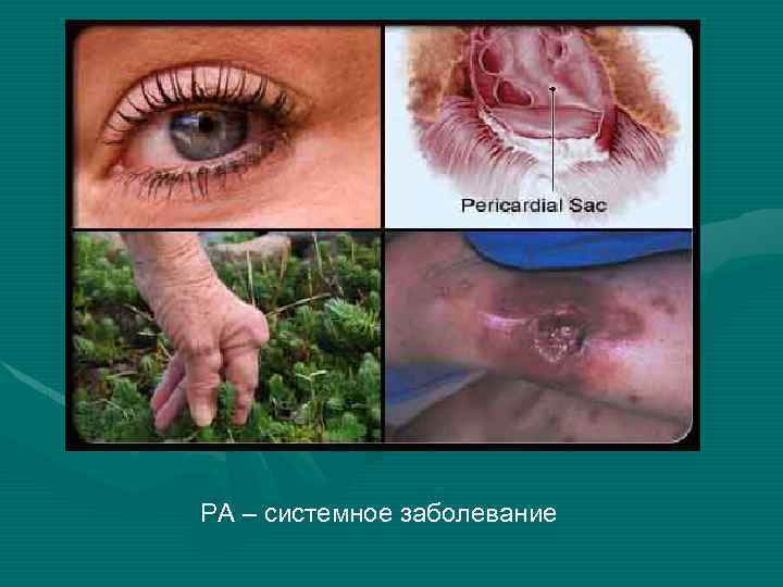 РА – системное заболевание 