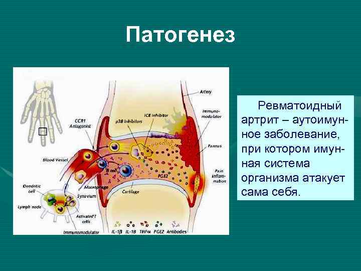 Патогенез ревматоидного артрита схема