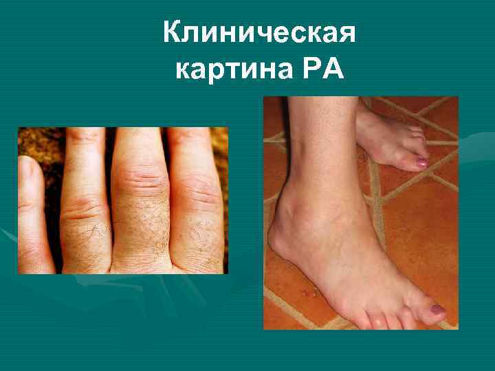 Клиническая картина РА 