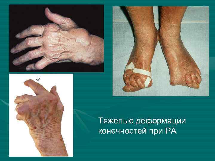 Тяжелые деформации конечностей при РА 