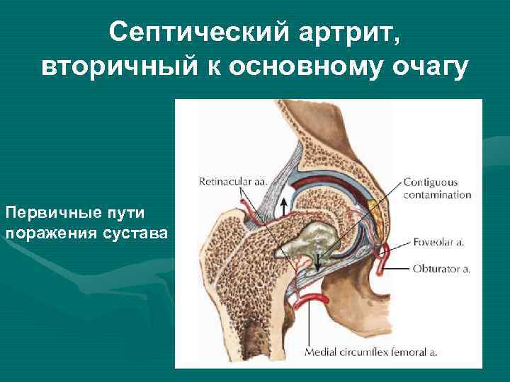 Септический артрит, вторичный к основному очагу Первичные пути поражения сустава 
