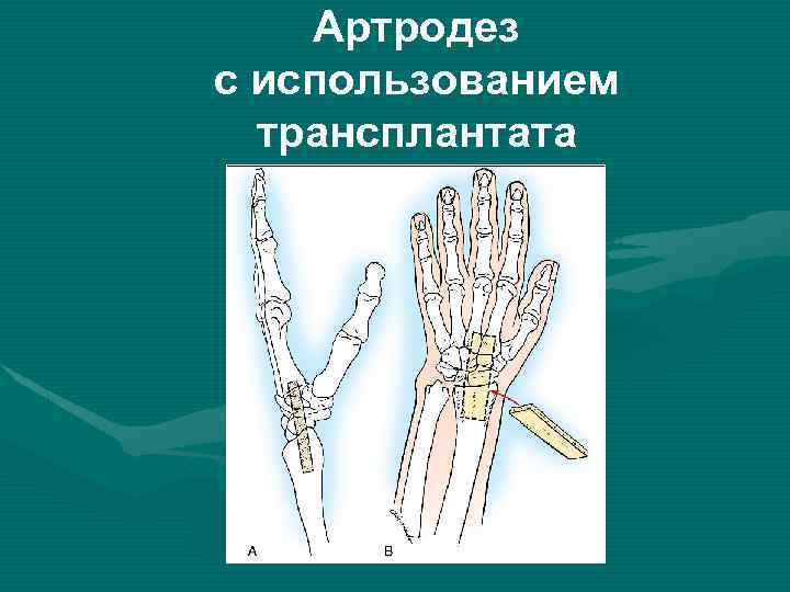 Артродез с использованием трансплантата 