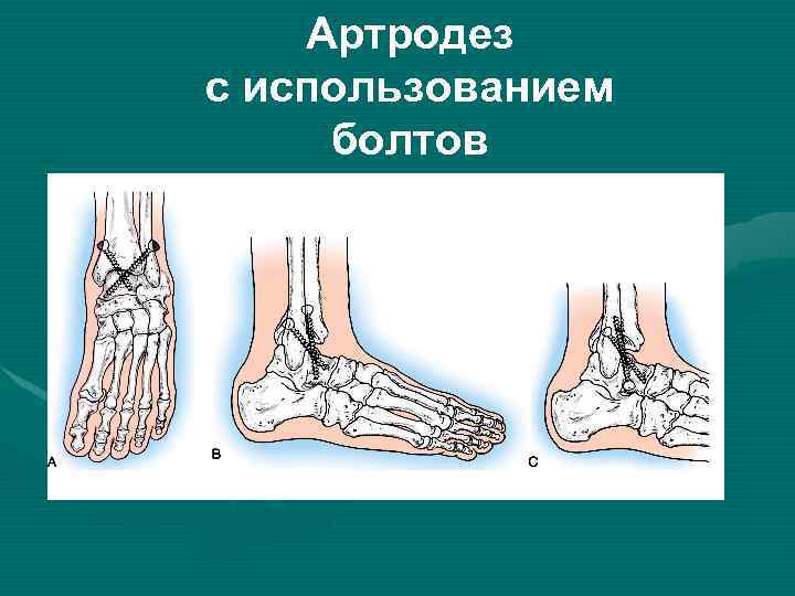 Артродез с использованием болтов 