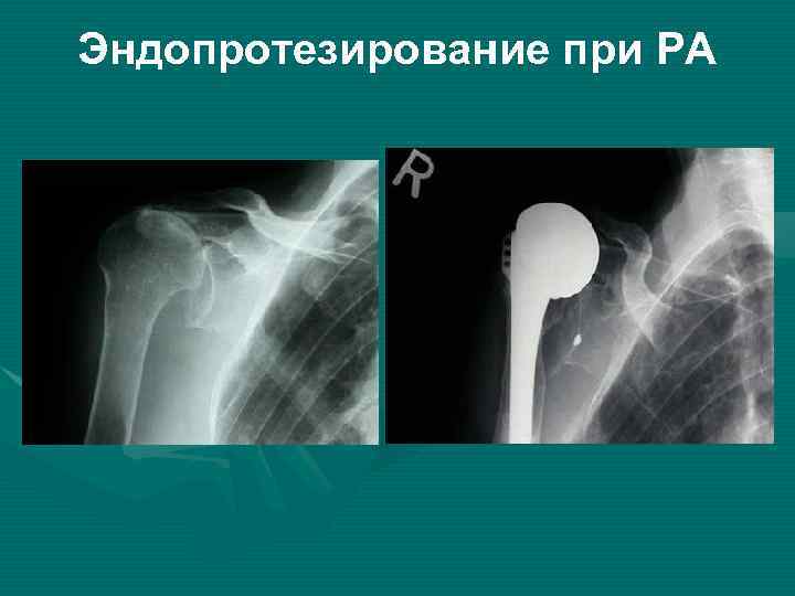 Эндопротезирование при РА 