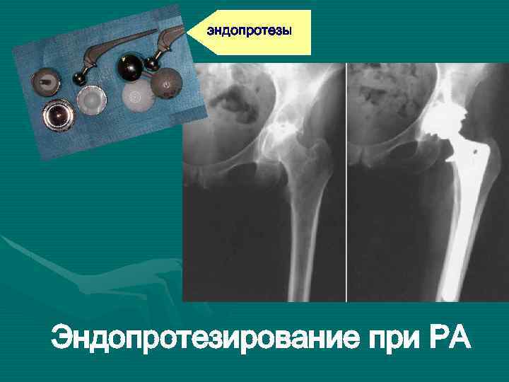 эндопротезы Эндопротезирование при РА 