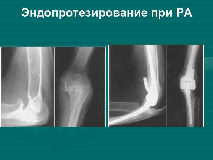 Эндопротезирование при РА 
