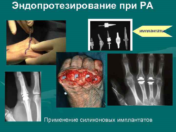 Эндопротезирование при РА имплантаты Применение силиконовых имплантатов 