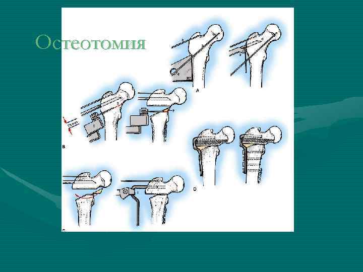 Остеотомия 