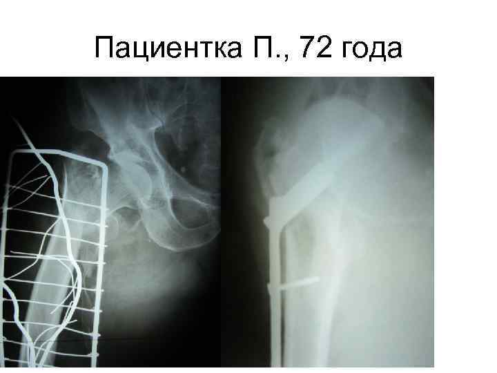 Пациентка П. , 72 года 