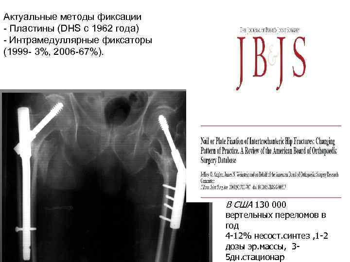Актуальные методы фиксации - Пластины (DHS с 1962 года) - Интрамедуллярные фиксаторы (1999 -