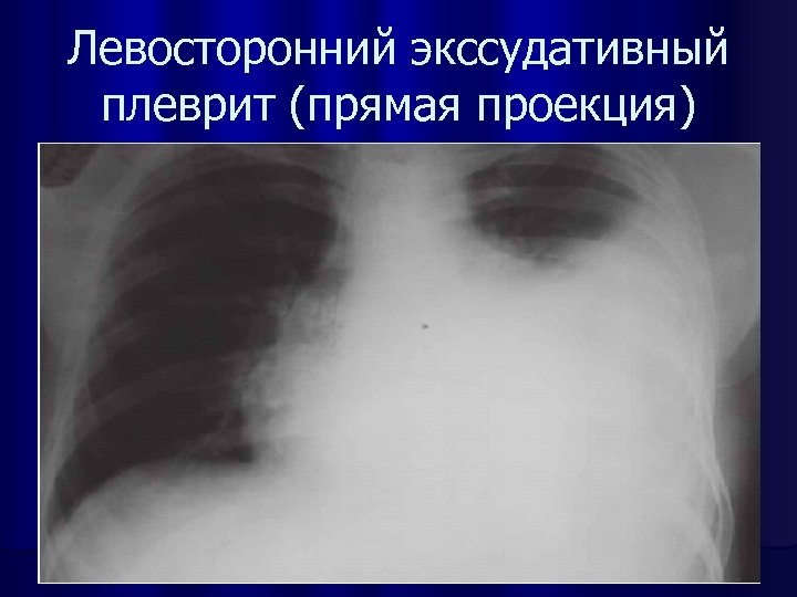 Левосторонний экссудативный плеврит (прямая проекция) 