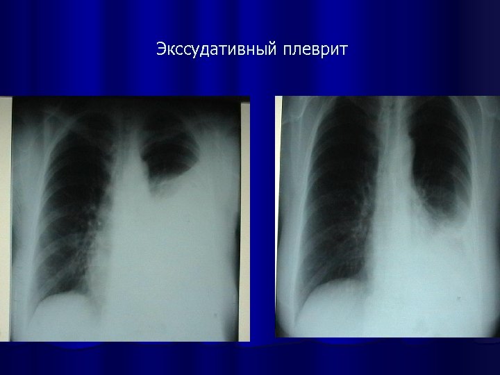 Экссудативный плеврит 