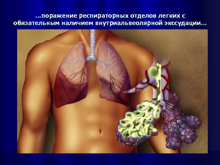 …поражение респираторных отделов легких с обязательным наличием внутриальвеолярной экссудации… 