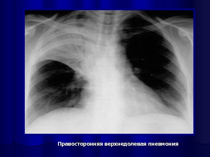 Правосторонняя верхнедолевая пневмония 