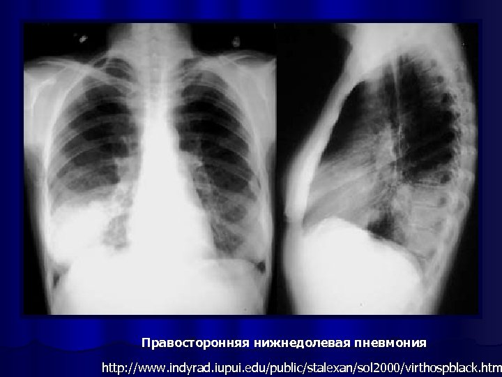 Правосторонняя нижнедолевая пневмония http: //www. indyrad. iupui. edu/public/stalexan/sol 2000/virthospblack. htm 