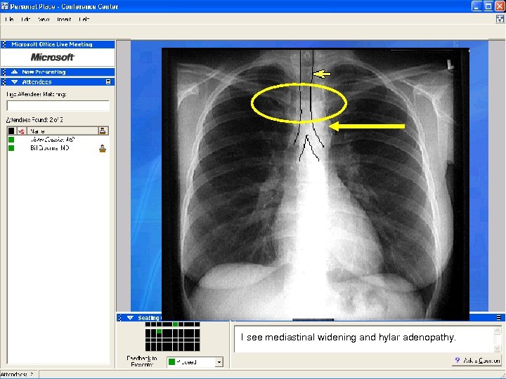 I see mediastinal widening and hylar adenopathy. 