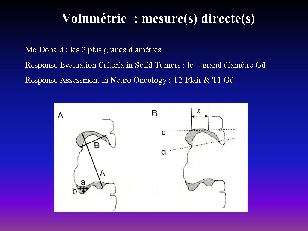 Volumétrie : mesure(s) directe(s) Mc Donald : les 2 plus grands diamètres Response Evaluation