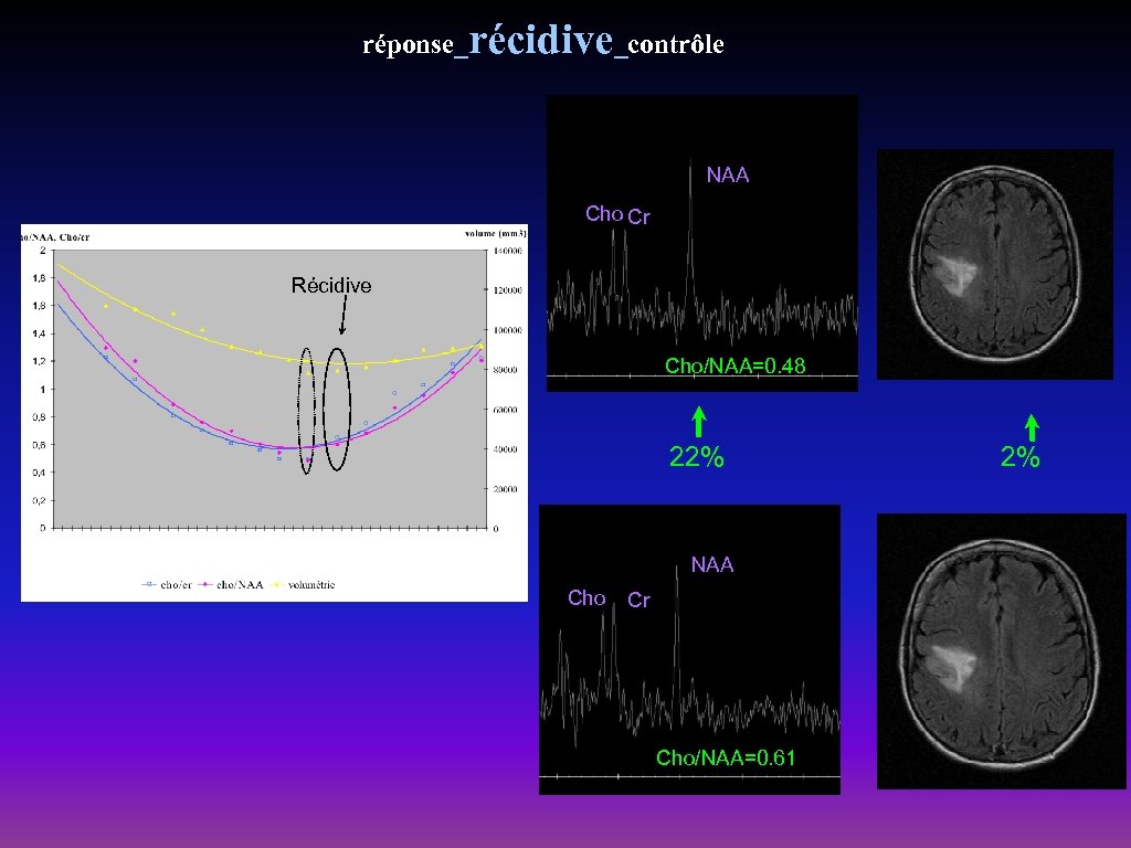 réponse_récidive_contrôle NAA Cho Cr Récidive Cho/NAA=0. 48 22% NAA Cho Cr Cho/NAA=0. 61 2%