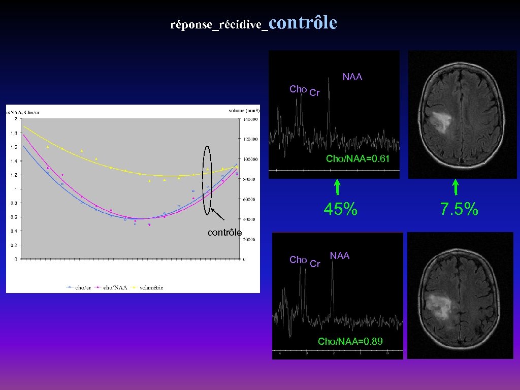 réponse_récidive_contrôle NAA Cho Cr Cho/NAA=0. 61 45% contrôle Cho Cr NAA Cho/NAA=0. 89 7.