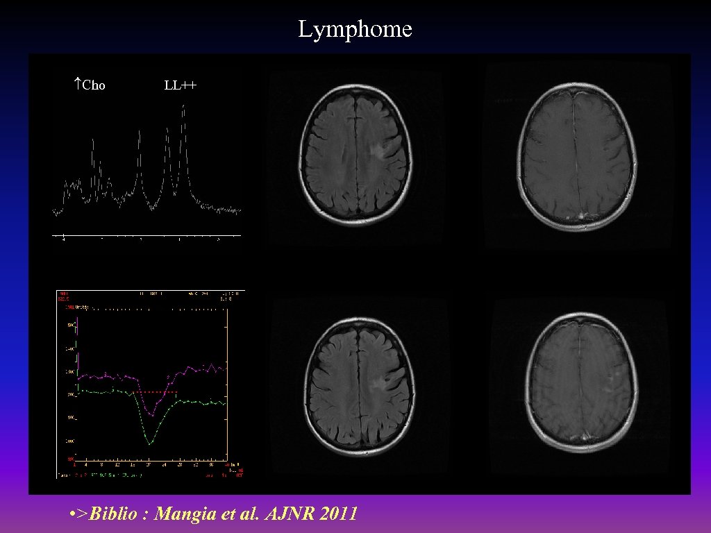  Lymphome Cho LL++ • >Biblio : Mangia et al. AJNR 2011 