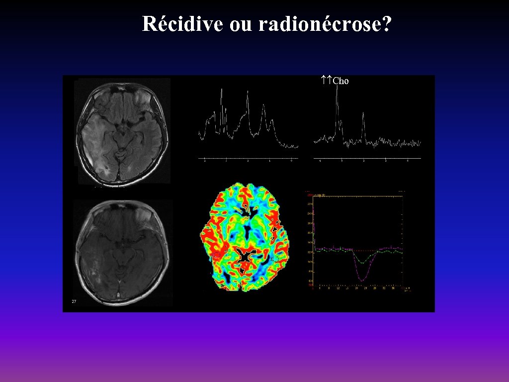 Récidive ou radionécrose? Cho 