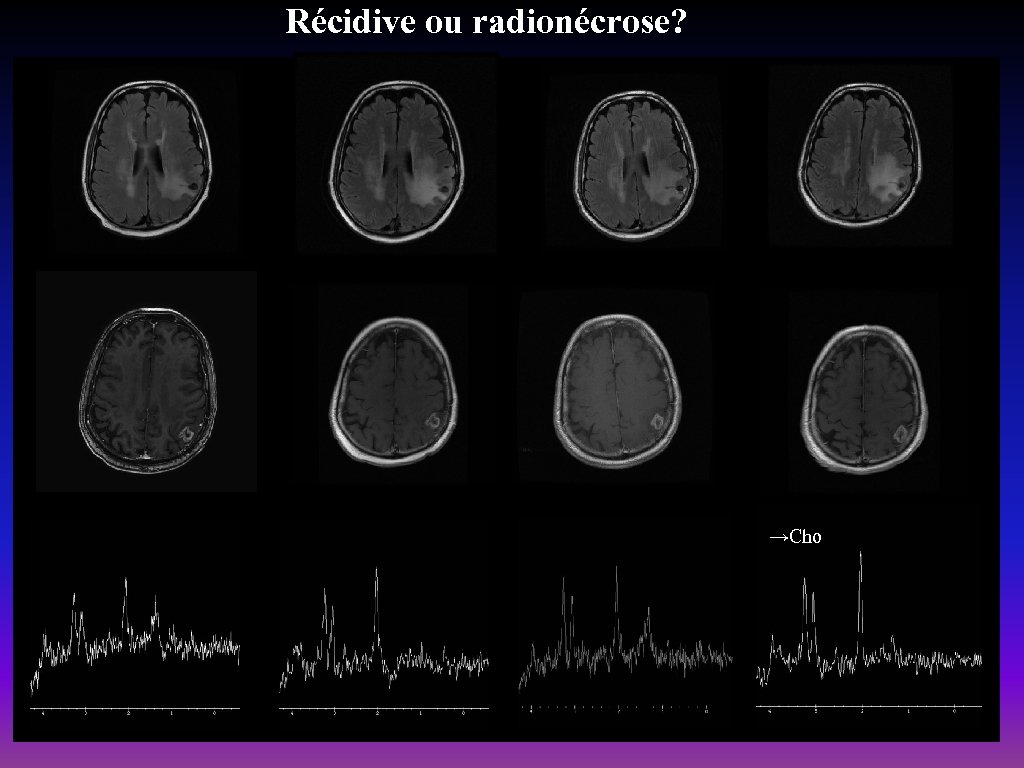 Récidive ou radionécrose? →Cho 