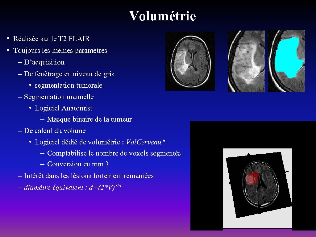 Volumétrie • Réalisée sur le T 2 FLAIR • Toujours les mêmes paramètres –